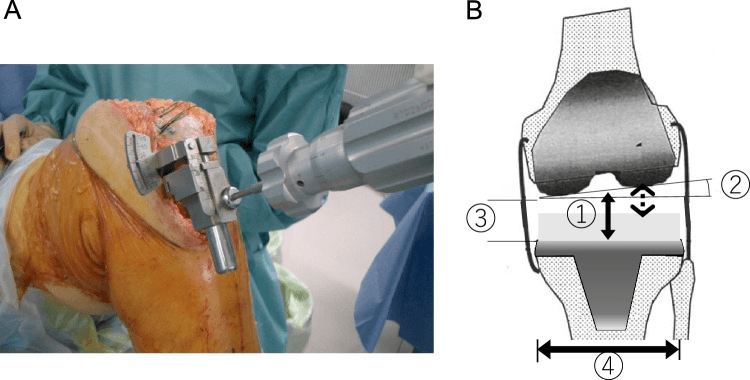 Offset tensor measuring total-knee component gap and lateral laxity at extension and 90 degrees flexion