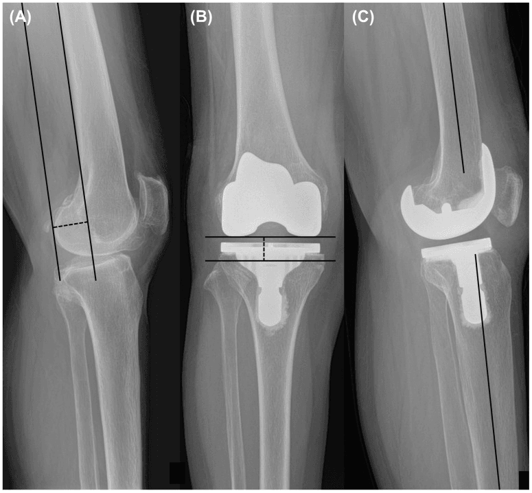 Knee radiographs showing posterior condylar offset measured on a lateral view of the native knee, and joint-line distance and extension angle measured after TKA
