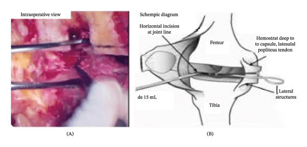 Intraoperative and schematic views of an inside-out posterolateral capsular release during valgus TKA
