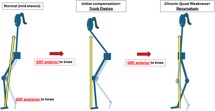 Biomechanical diagram showing how quadriceps weakness shifts the ground-reaction force anterior to the knee and produces recurvatum