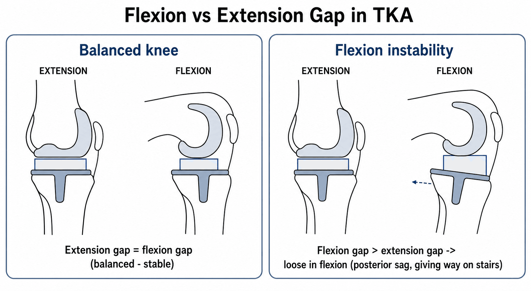Diagram comparing a balanced total knee replacement (equal extension and flexion gaps) with flexion instability (flexion gap larger than extension gap, with posterior tibial sag in flexion).