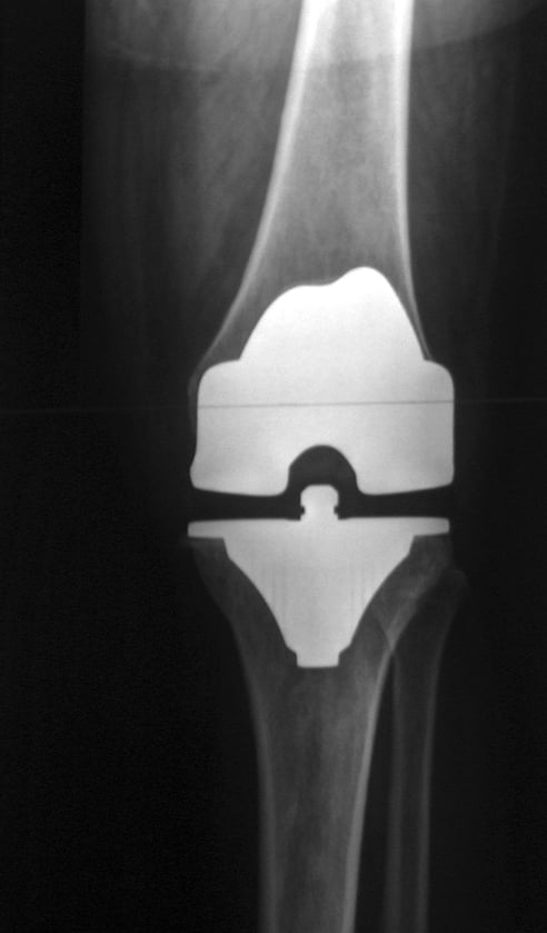 Anteroposterior radiograph of a posterior-stabilised total knee replacement