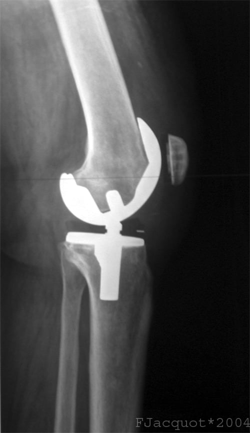 Lateral radiograph of a posterior-stabilised total knee replacement