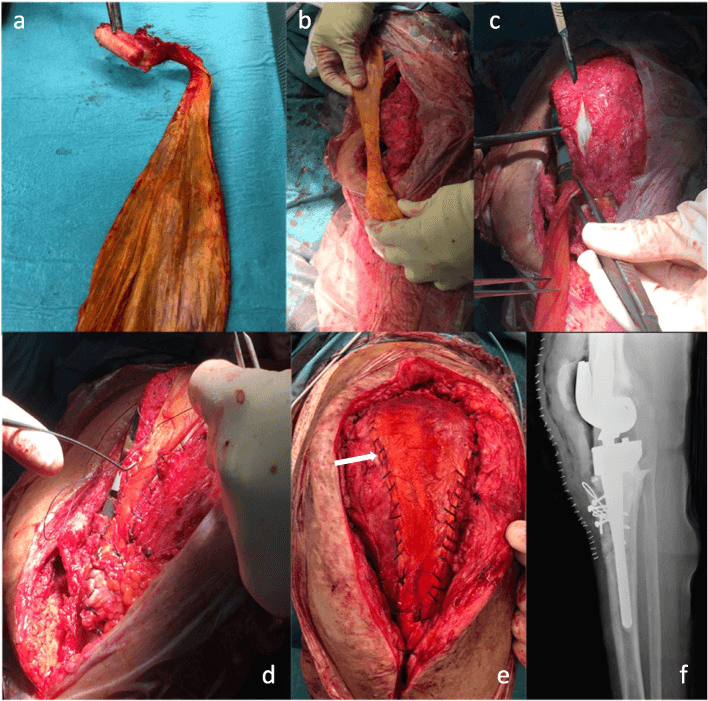 Achilles allograft reconstruction sequence, panels a to f, for patellar tendon failure after infected TKA
