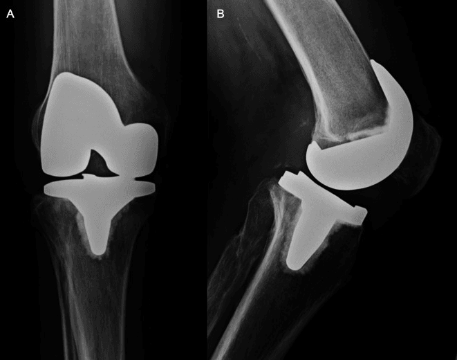 Panel A AP and panel B lateral radiographs of a TKA in chronic quadriceps tendon insufficiency