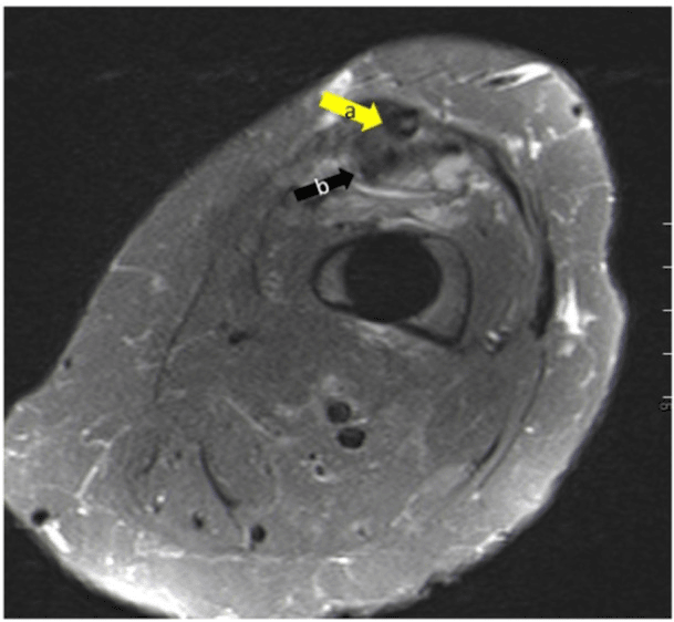 Axial MRI through the thigh with arrows a and b marking the reconstructed graft and intact quadriceps fibres