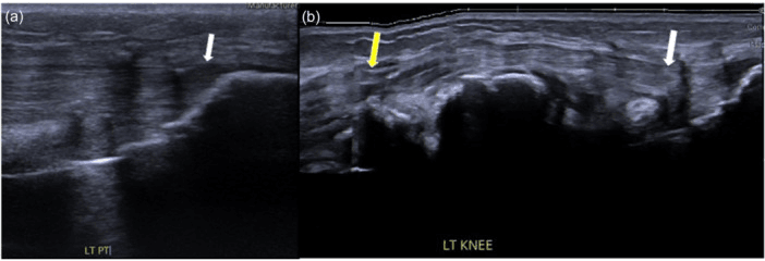 Two ultrasound panels of a left knee, one panoramic, showing an intact extensor graft six months after reconstruction