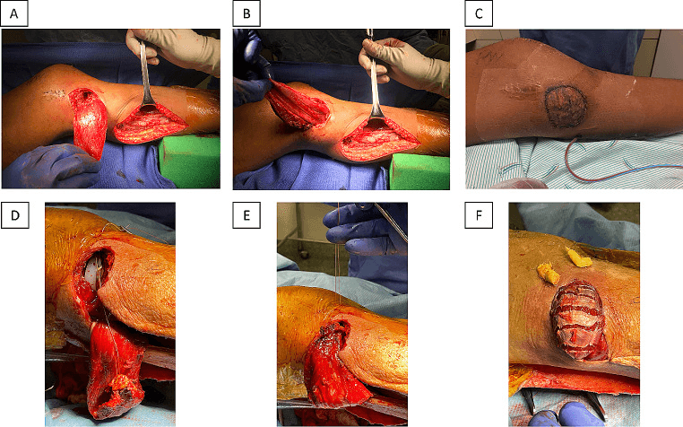 Operative photographs, panels A to F, of a gastrocnemius muscle flap raised in the calf and rotated over the anterior knee