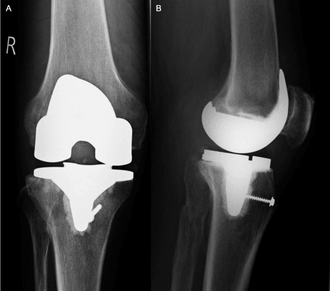 AP and lateral radiographs after polypropylene mesh extensor reconstruction, with a screw in the anterior proximal tibia