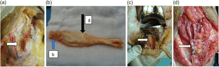 Four operative panels, a to d, of a bone-block graft reconstruction of post-TKA patellar tendon disruption