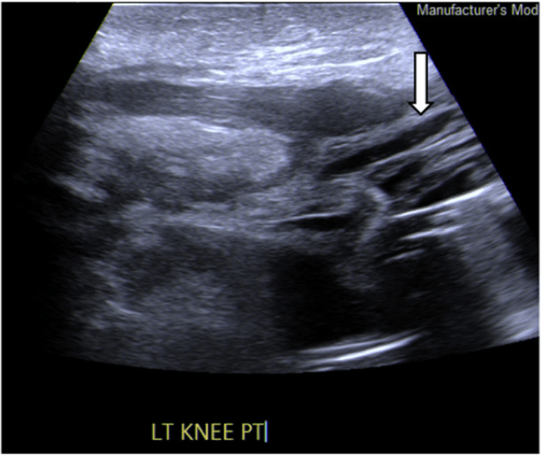 Ultrasound of the patellar tendon of a left knee, labelled LT KNEE PT, with an arrow at a patellar tendon rupture after TKA