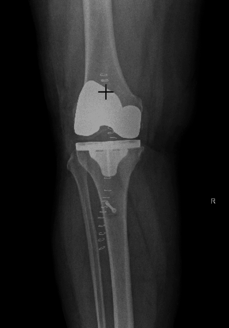 AP radiograph after Achilles allograft reconstruction of post-TKA patellar tendon rupture, showing the components, skin staples and a tibial screw