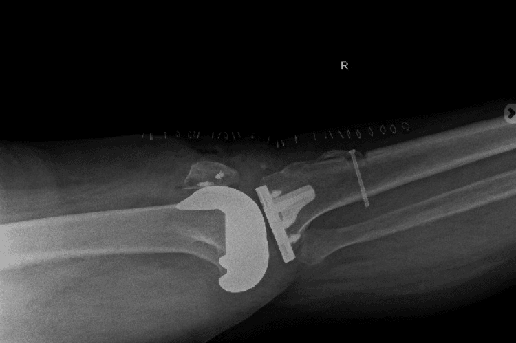 Postoperative lateral radiograph after Achilles allograft reconstruction showing the patella, TKA components, skin staples and a tibial screw