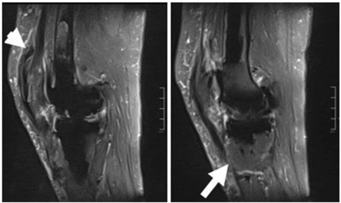 Two long-axis MRI panels showing extensor graft continuity seven years after reconstruction