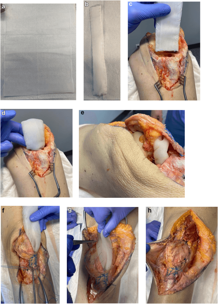 Folded polypropylene mesh fixation and soft-tissue coverage in extensor reconstruction, panels a to h