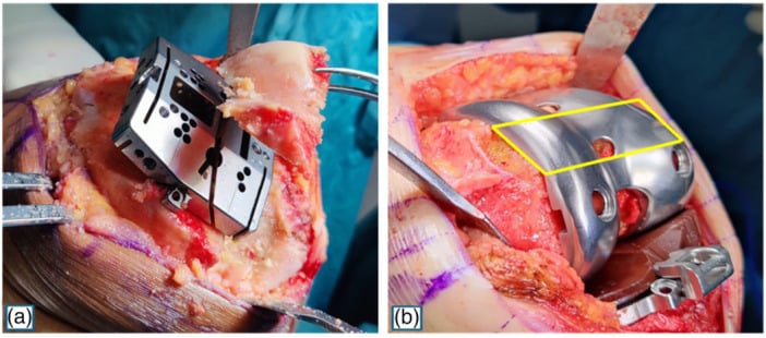 Intraoperative photographs: (a) a cutting block on the distal femur, (b) the femoral implant in place with an area of its anterior surface outlined in yellow