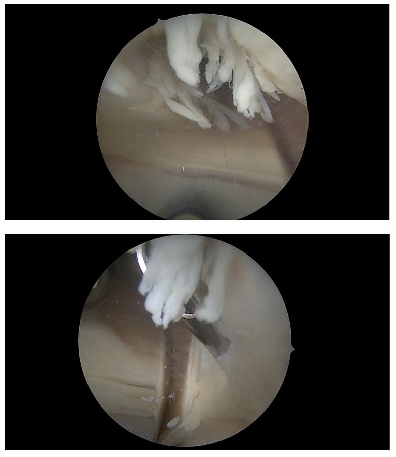 Two arthroscopic views of fibrous tissue after TKA, a shaver resecting it in the lower view