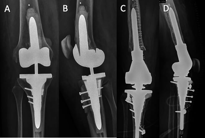 AP and lateral radiographs of stemmed revision TKAs after extensor-mechanism allograft, with screws in the proximal tibia