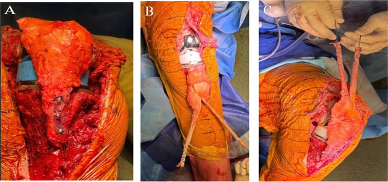 Operative sequence: (A) allograft bone block screwed to the host tibia, (B) the graft laid along the knee, (C) the two quadriceps limbs held under tension