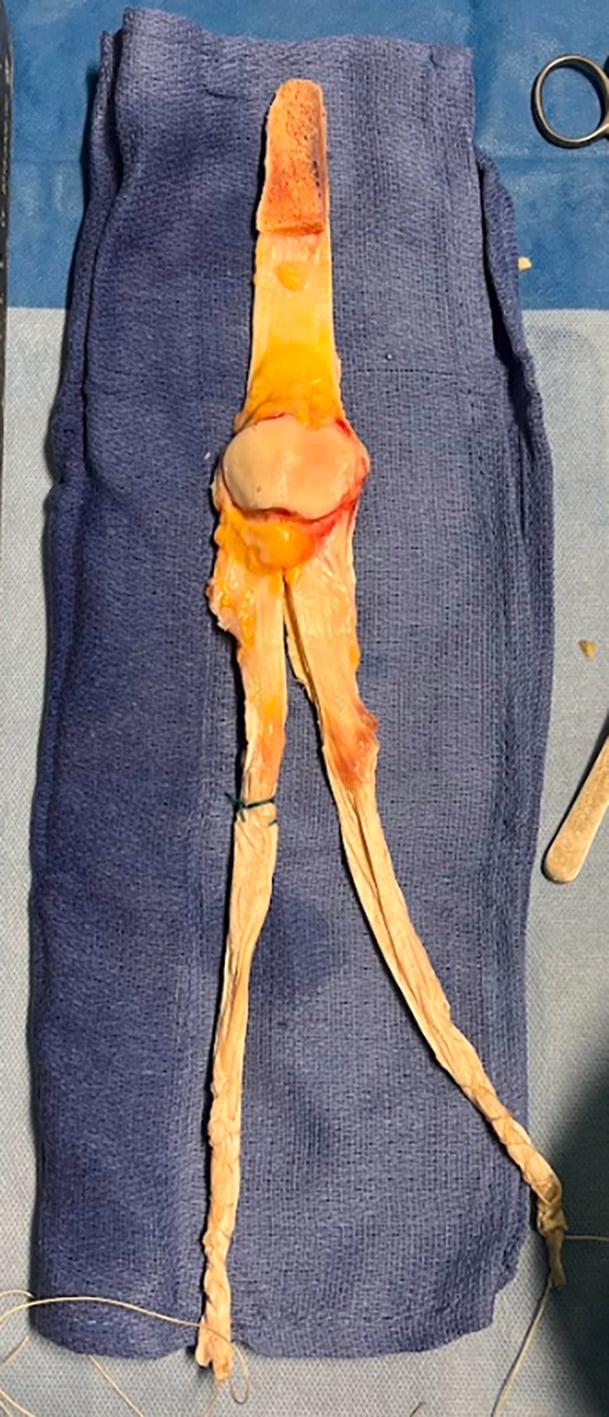 Prepared composite extensor-mechanism allograft: tibial-tubercle bone block, patellar tendon, patella and a quadriceps tendon split into two sutured limbs