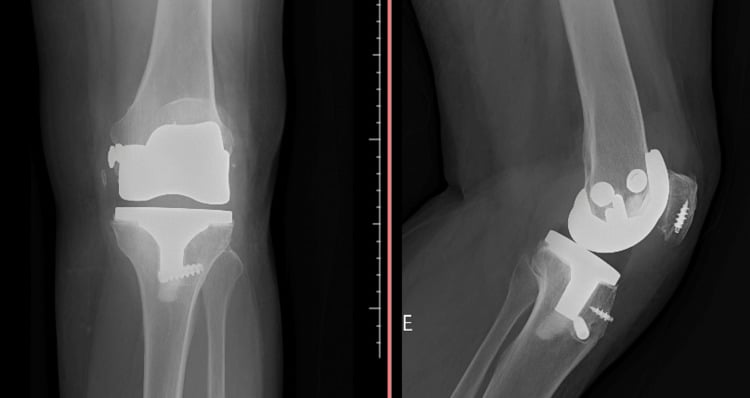 AP and lateral radiographs after extensor-mechanism reconstruction following TKA, with fixation devices in the patella and proximal tibia