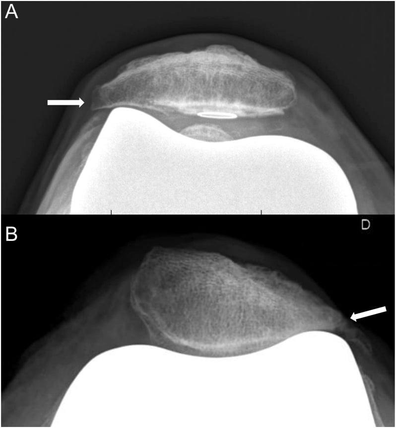 Skyline radiographs after TKA with arrows at the patellar facet margin: panel A a patella with a resurfacing-button marker ring, panel B a patella without one