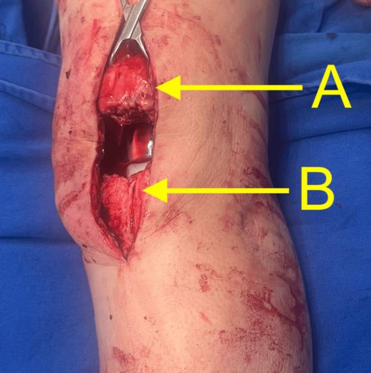 Operative exposure of a patellar-tendon rupture after TKA, labels A and B on either side of the gap