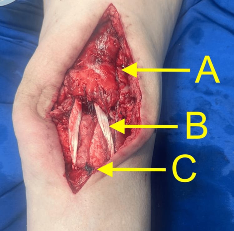 Operative extensor-mechanism reconstruction using peroneus-longus autograft, labels A to C along the repair