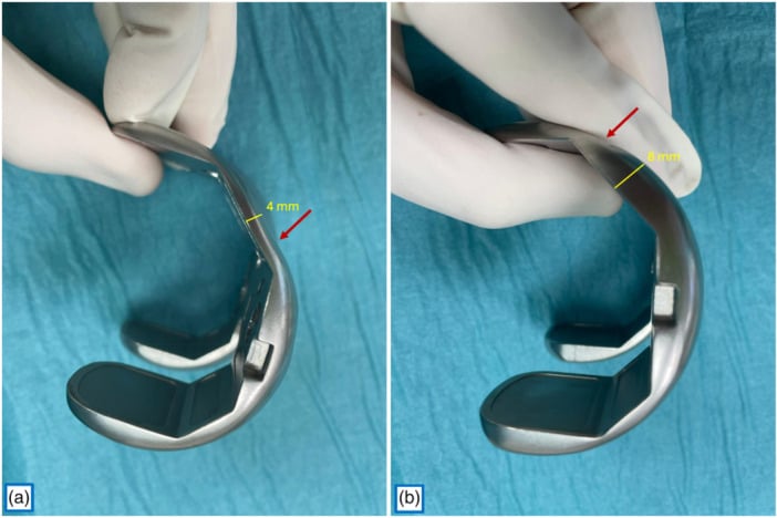 Femoral component anterior flange thickness marked in yellow, 4 mm in panel a and 8 mm in panel b