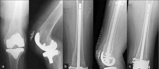 Supracondylar periprosthetic fracture treated with retrograde intramedullary nail