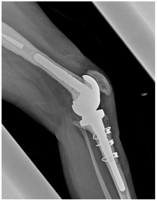 Lateral radiograph after tibial tubercle osteotomy in revision total knee arthroplasty showing cerclage wire fixation