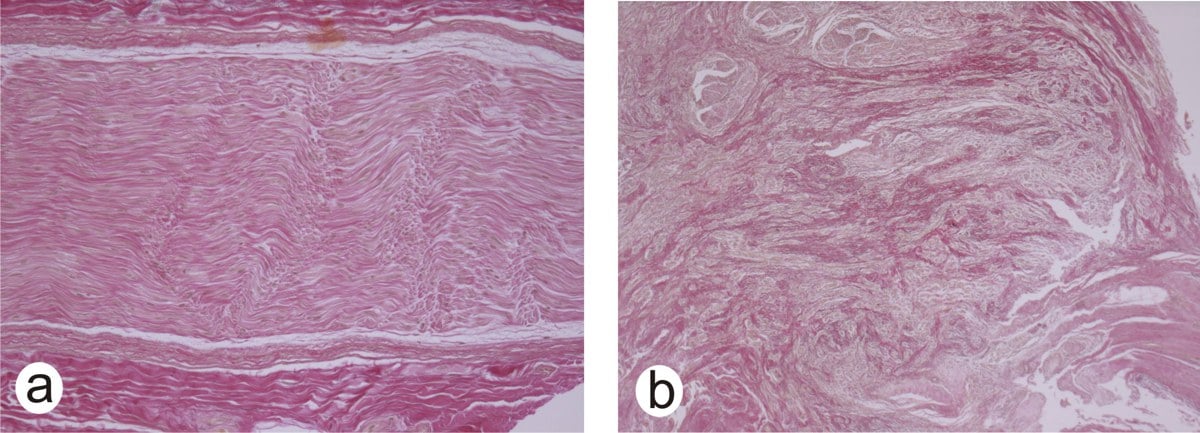 Two-panel histology showing the pathology and mechanism of a traumatic neuroma versus a normal aligned nerve (Elastica-van-Gieson stain)