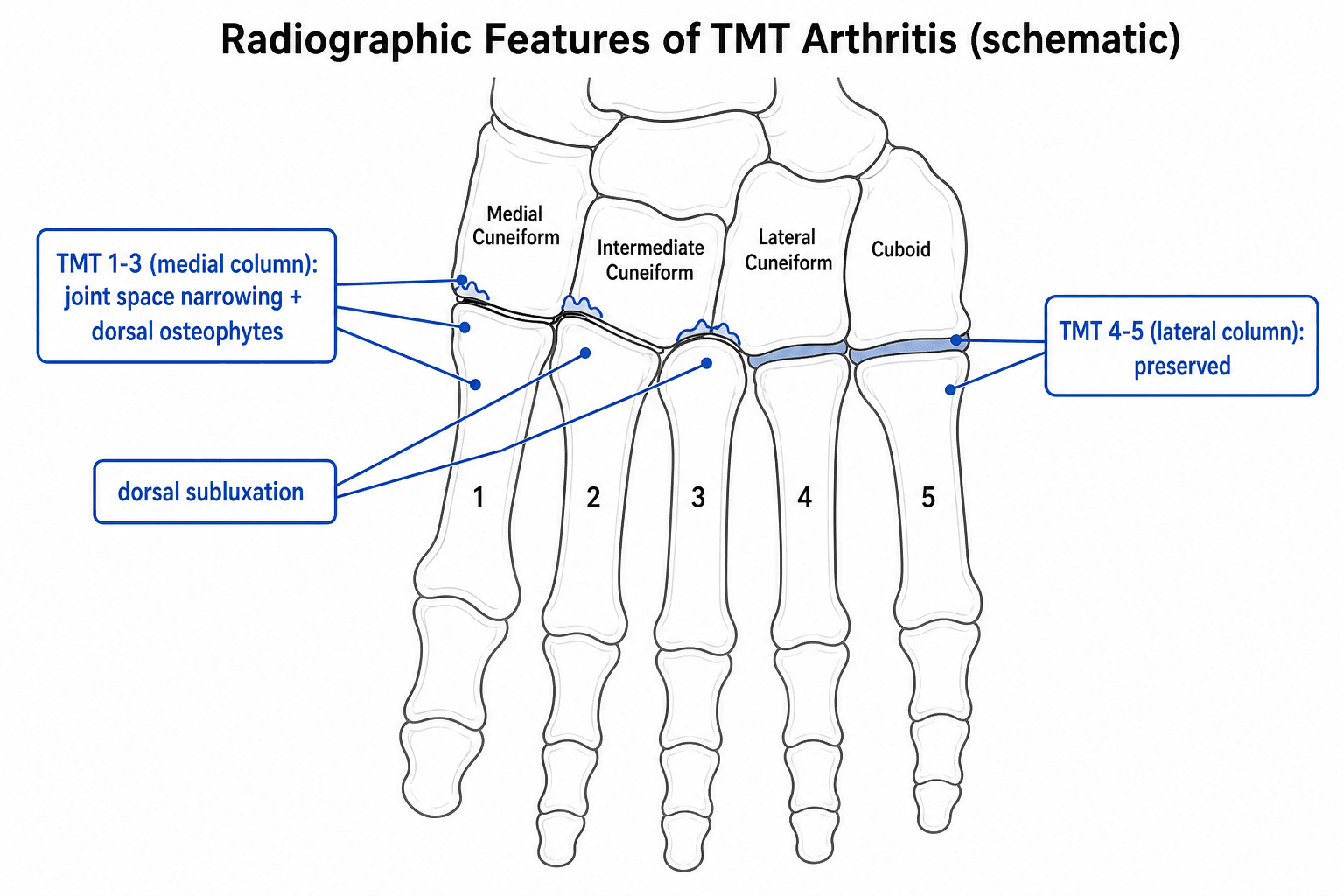 Schematic of a dorsal foot outline showing radiographic features of TMT arthritis: joint space narrowing and dorsal osteophytes at TMT 1-3, dorsal subluxation, and preserved TMT 4-5
