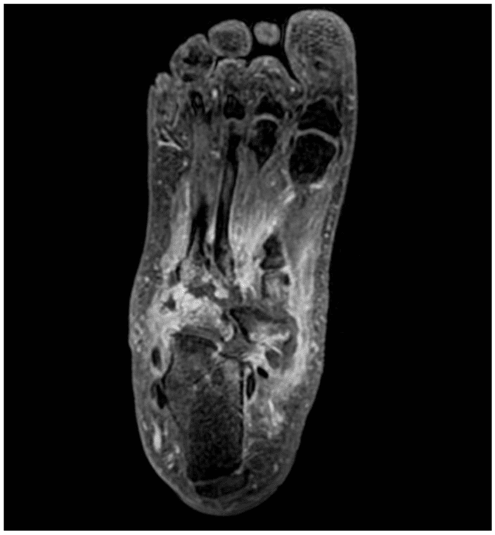MRI of active Charcot showing periarticular high signal and surrounding inflammatory change across multiple midfoot joints