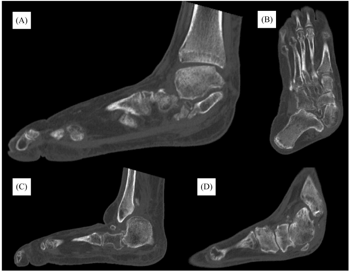 Multiplanar CT of advanced Charcot pes planus and midfoot collapse