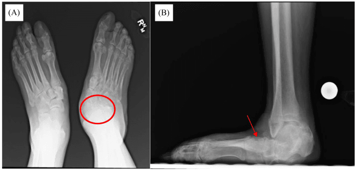 AP radiograph of both feet and lateral radiograph showing Charcot midfoot collapse