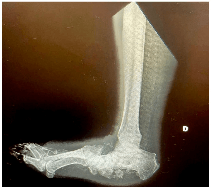 Lateral radiograph showing rocker-bottom Charcot deformity with midfoot collapse and fragmentation