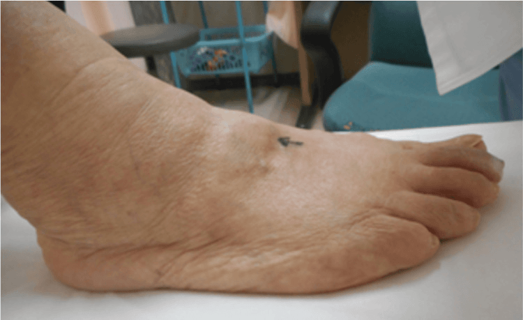 Clinical photograph of a dorsal midfoot boss marked with an arrow on the skin