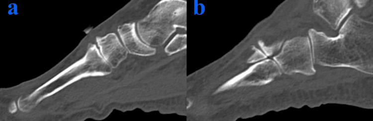 Sagittal CT, panels a and b, of dorsal TMT osteophytes