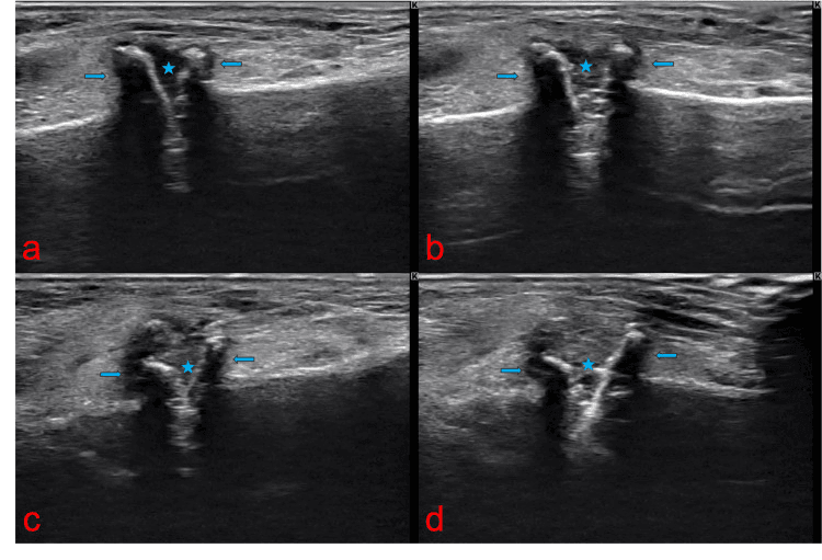 Four ultrasound panels (a-d) of the TMT joints, each with a star at the joint and arrows either side