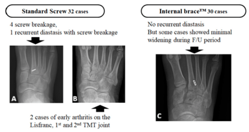 Radiographs comparing standard screw and Internal Brace fixation after Lisfranc injury, with screw breakage and early TMT arthritis in the screw group