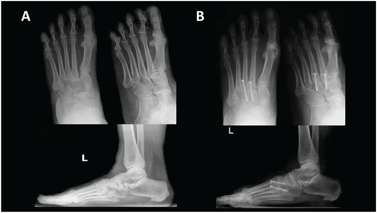 Preoperative TMT2-3 arthritis and postoperative radiographs after selective screw arthrodesis