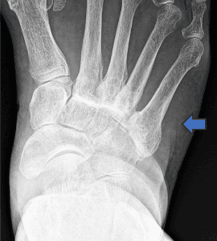 Dorsoplantar foot radiograph showing sclerotic, irregular TMT joint margins, with a blue arrow at the lateral border of the foot