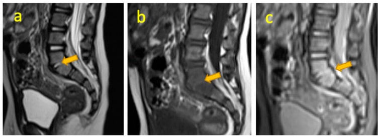 Sagittal MRI sequences in a 13-month-old child showing L5-S1 discitis.