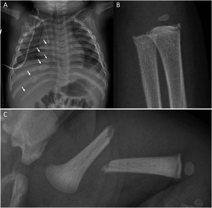 Radiographic examples of healing posterior rib fractures, distal radius and ulna classic metaphyseal lesions, and an acute displaced femoral shaft fracture in infants.