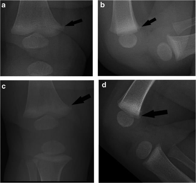 AP and lateral radiographs showing unchanged distal femoral metaphyseal fragmentation at 14-day follow-up.