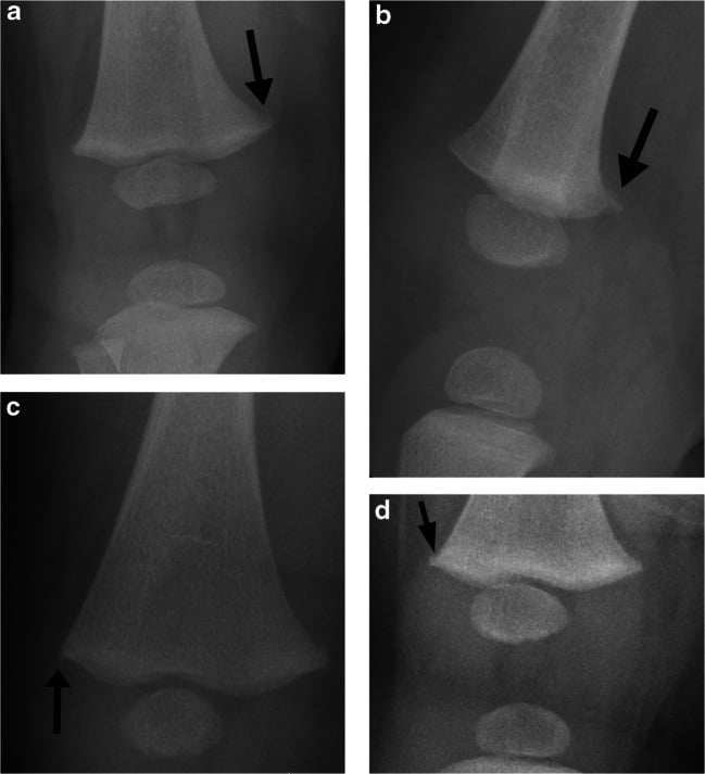 Four radiographs demonstrating normal infant metaphyseal fragmentation, spur and step-off variants.