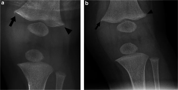 Initial and 15-day follow-up radiographs of a subtle distal femoral classic metaphyseal lesion.