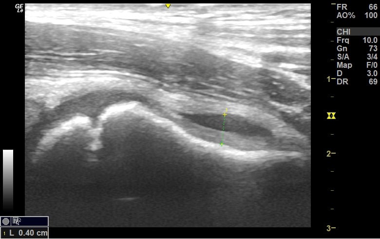 Long-axis point-of-care ultrasound of a paediatric hip showing a measured anterior joint effusion.