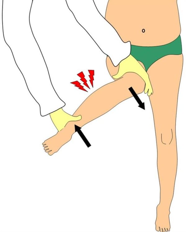 Clinical examination illustration showing how passive hip rotation transmits shear through an injured toddler tibia.